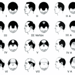 Hair loss chart